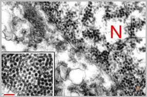 F,50y. | papilomavirus in glial cell - progressive multifocal leukodystrophy F,50y. | papilomavirus in glial cell - progressive multifocal leukodystrophy